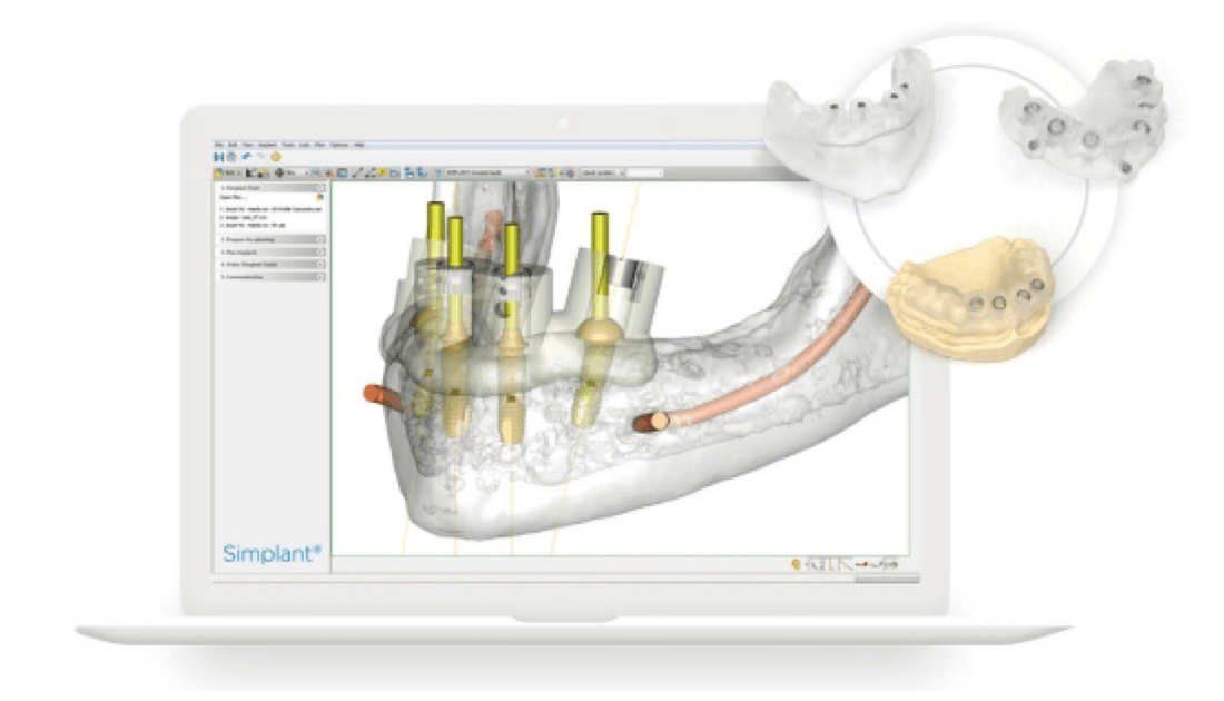 シムプラント画像